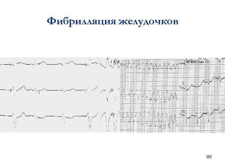 Фибрилляция желудочков 66 