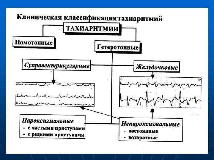 Блок схема классификация аритмий