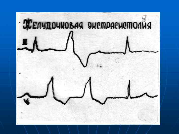 Нарушение ритма жизни. Классификация ЭКГ аритмий. Жизнеугрожающая аритмия. Нарушения ритма сердца угрожающие жизни. Неопределённый ритм сердца.