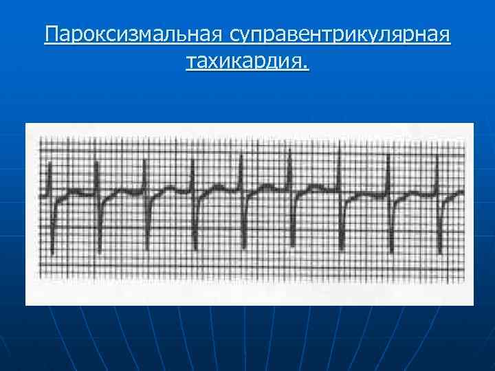 Что такое пароксизмальная тахикардия