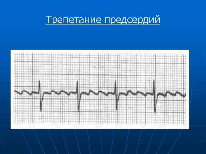 Трепетание предсердий 