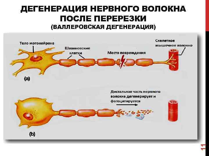 ДЕГЕНЕРАЦИЯ НЕРВНОГО ВОЛОКНА ПОСЛЕ ПЕРЕРЕЗКИ 11 (ВАЛЛЕРОВСКАЯ ДЕГЕНЕРАЦИЯ) 