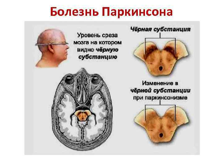 Болезнь Паркинсона 