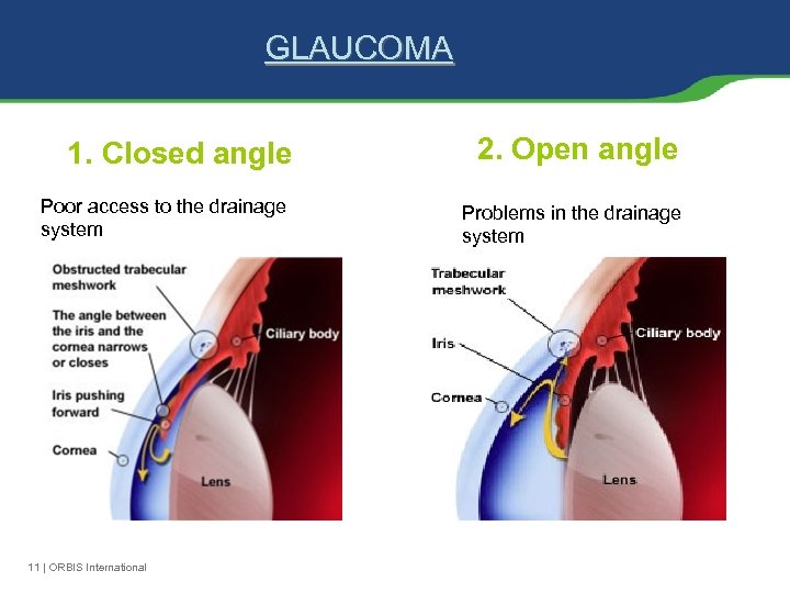 GLAUCOMA 1. Closed angle Poor access to the drainage system 11 | ORBIS International