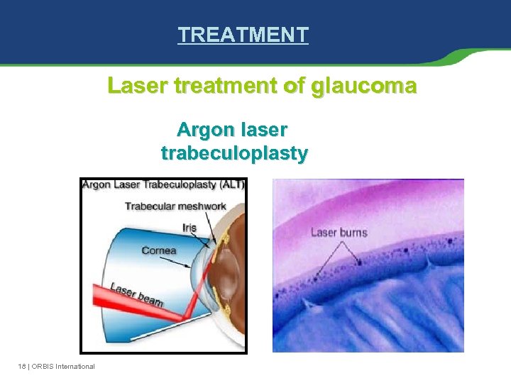 TREATMENT Laser treatment of glaucoma Argon laser trabeculoplasty 18 | ORBIS International 