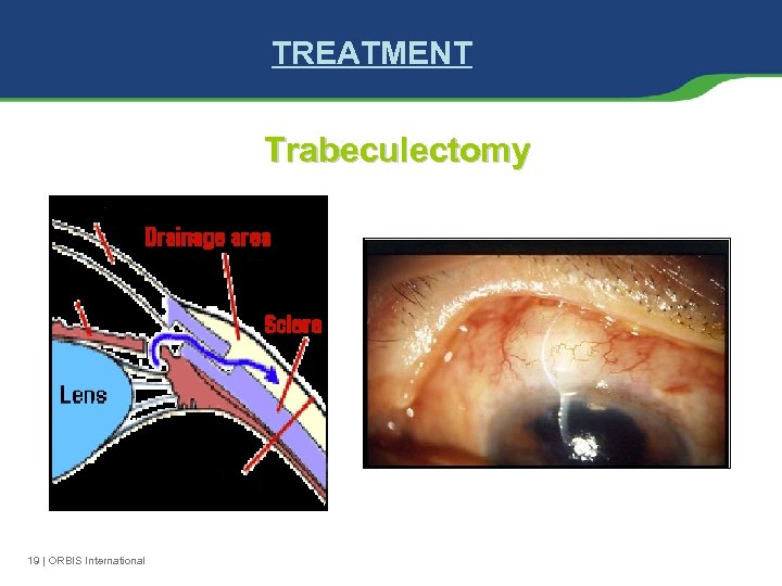 TREATMENT Trabeculectomy 19 | ORBIS International 