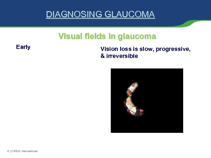 DIAGNOSING GLAUCOMA Visual fields in glaucoma Early 8 | ORBIS International Vision loss is