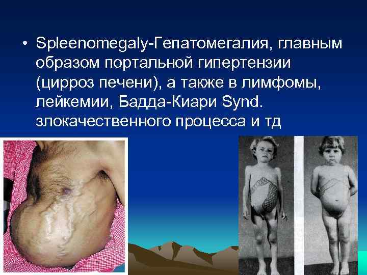  • Spleenomegaly-Гепатомегалия, главным образом портальной гипертензии (цирроз печени), а также в лимфомы, лейкемии,