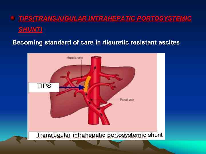 TIPS(TRANSJUGULAR INTRAHEPATIC PORTOSYSTEMIC SHUNT) Becoming standard of care in dieuretic resistant ascites 