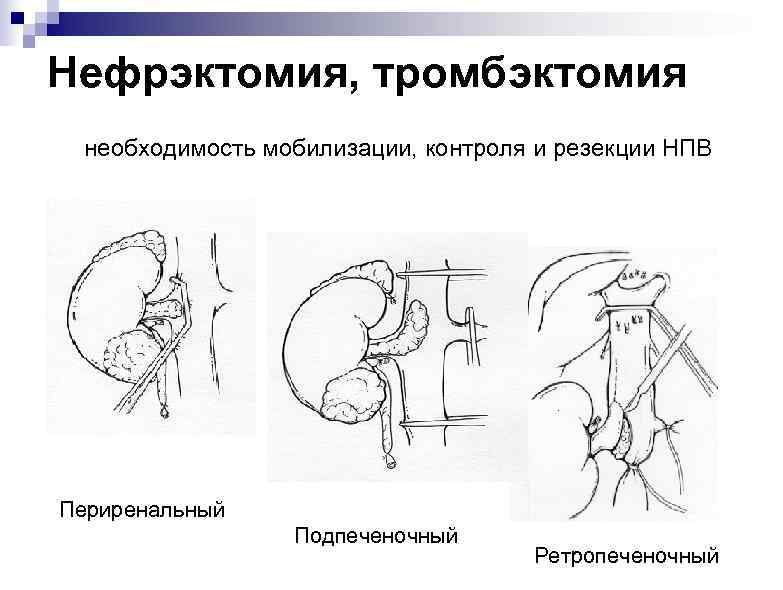 Нефрэктомия