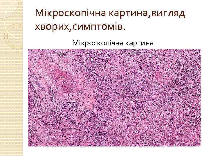 Мікроскопічна картина, вигляд хворих, симптомів. Мікроскопічна картина 