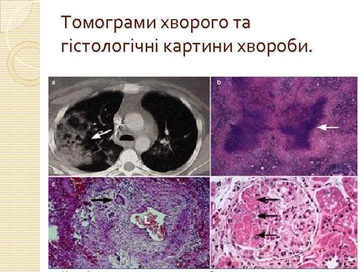 Томограми хворого та гістологічні картини хвороби. 