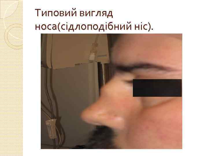 Типовий вигляд носа(сідлоподібний ніс). 