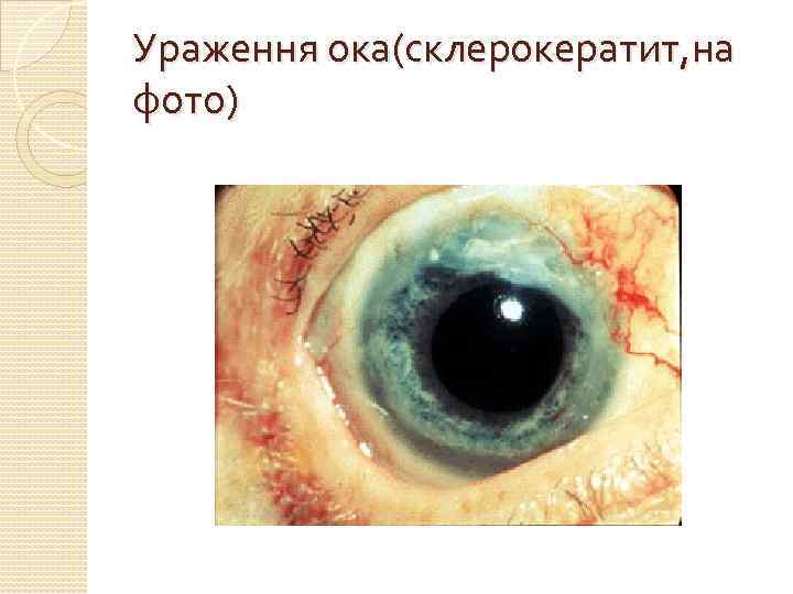 Ураження ока(склерокератит, на фото) 