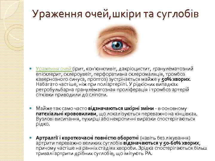 Ураження очей, шкіри та суглобів Ураження очей (ірит, кон'юнктивіт, дакріоцистит, гранулёматозний епісклерит, склероувеіт, перфоративна