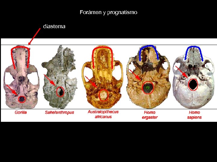 Forámen y prognatismo diastema 