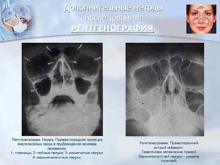 Дополнительные методы исследования: РЕНТГЕНОГРАФИЯ. Рентгенограмма. Норма. Прямая передняя проекция околоносовых пазух в подбородочно-носовом положении.