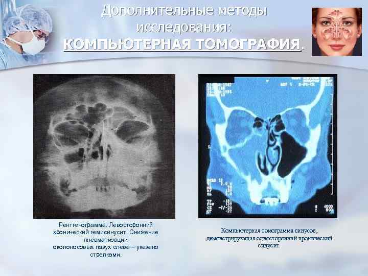 Дополнительные методы исследования: КОМПЬЮТЕРНАЯ ТОМОГРАФИЯ. Рентгенограмма. Левосторонний хронический гемисинусит. Снижение пневматизации околоносовых пазух слева