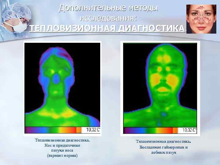 Дополнительные методы исследования: ТЕПЛОВИЗИОННАЯ ДИАГНОСТИКА. Тепловизионная диагностика. Нос и придаточные пазухи носа (вариант нормы)