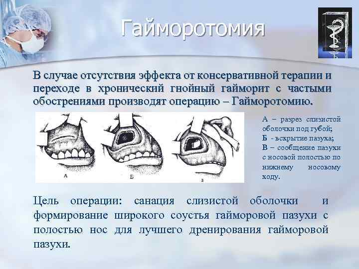 Гайморотомия В случае отсутствия эффекта от консервативной терапии и переходе в хронический гнойный гайморит