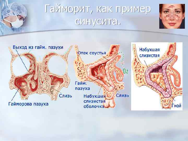 Гайморит, как пример синусита. 
