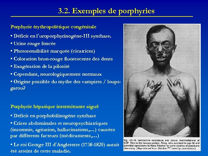 3. 2. Exemples de porphyries Porphyrie érythropoïétique congénitale • Déficit en l’uroporphyrinogène-III synthase. •