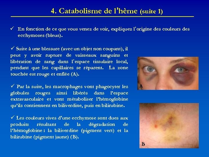 4. Catabolisme de l’hème (suite 1) En fonction de ce que vous venez de