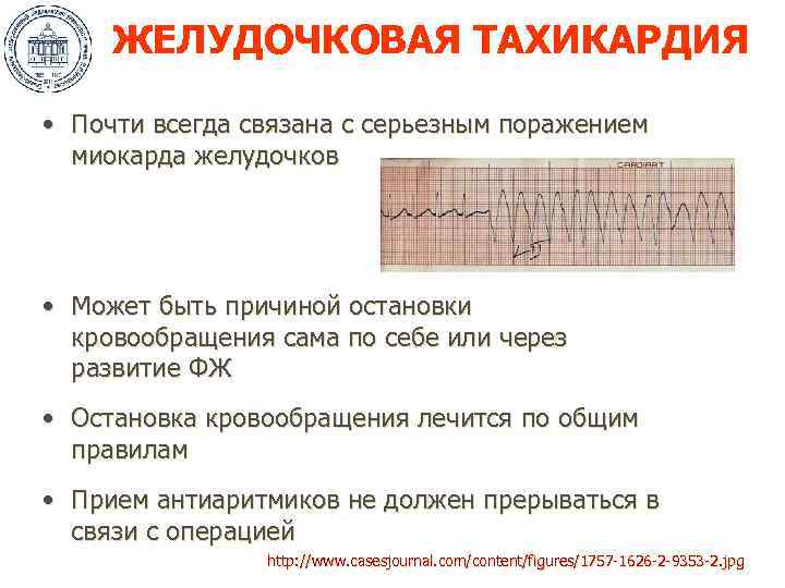 ЖЕЛУДОЧКОВАЯ ТАХИКАРДИЯ • Почти всегда связана с серьезным поражением миокарда желудочков • Может быть