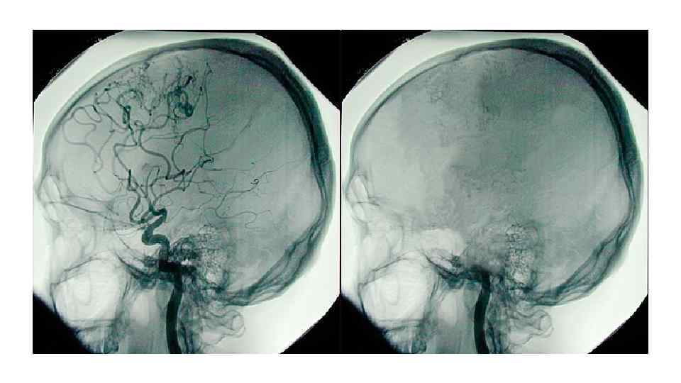 Фотка • Ангиография 4 х сосудистая 