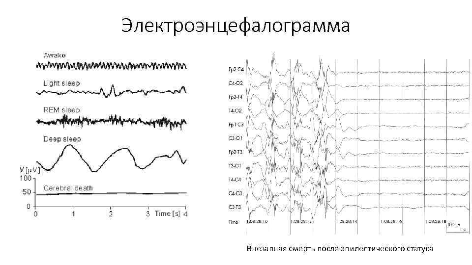 Электроэнцефалограмма Внезапная смерть после эпилептического статуса 