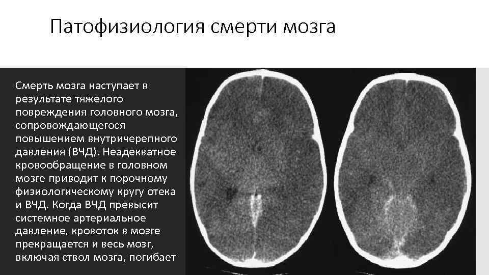 Патофизиология смерти мозга Смерть мозга наступает в результате тяжелого повреждения головного мозга, сопровождающегося повышением
