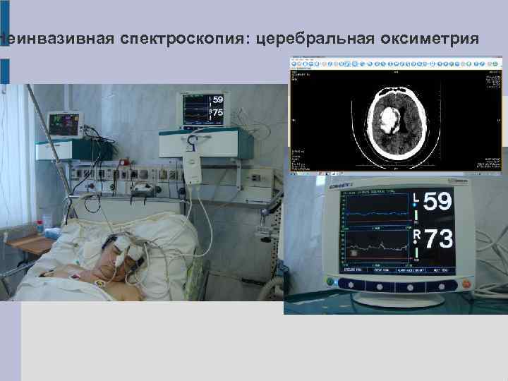 Неинвазивная спектроскопия: церебральная оксиметрия 