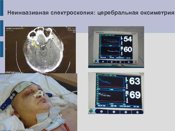 Неинвазивная спектроскопия: церебральная оксиметрия 