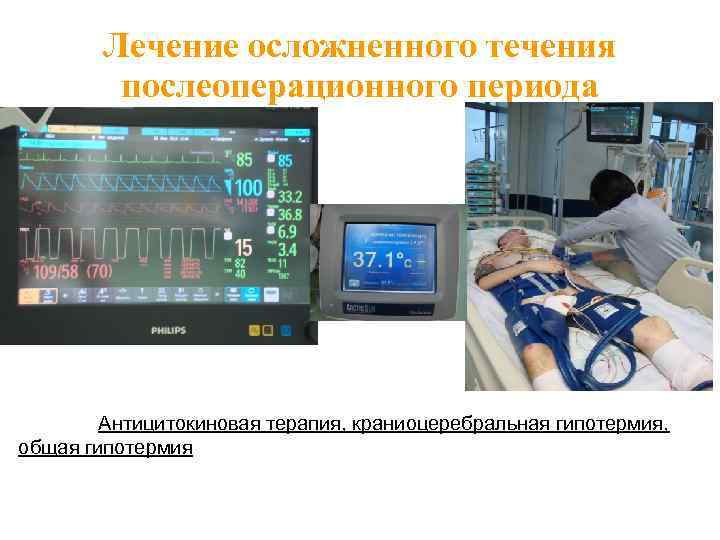 Лечение осложненного течения послеоперационного периода Регистрация на этапе удаления опухоли основания черепа нарушений сердечного