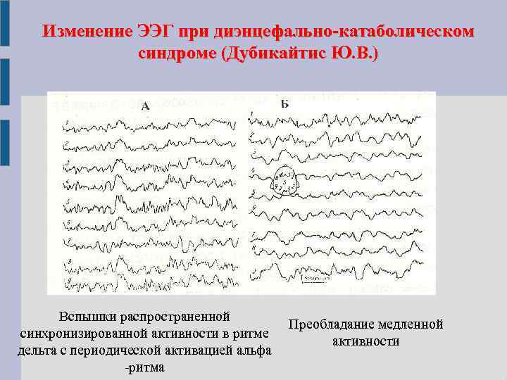 Изменение ЭЭГ при диэнцефально-катаболическом синдроме (Дубикайтис Ю. В. ) Вспышки распространенной синхронизированной активности в
