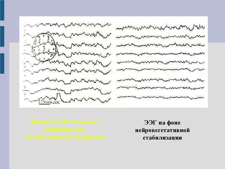 Фоновая ЭЭГ больного с диэнцефальнокатаболическим синдромом ЭЭГ на фоне нейровегетативной стабилизации 