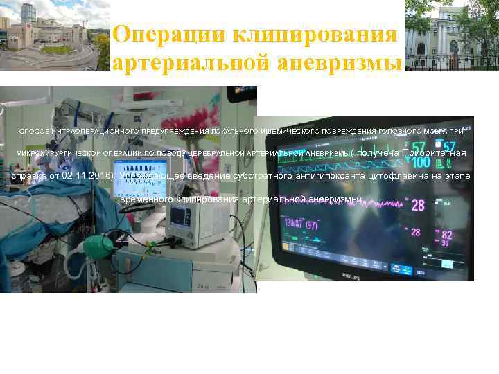 Операции клипирования артериальной аневризмы СПОСОБ ИНТРАОПЕРАЦИОННОГО ПРЕДУПРЕЖДЕНИЯ ЛОКАЛЬНОГО ИШЕМИЧЕСКОГО ПОВРЕЖДЕНИЯ ГОЛОВНОГО МОЗГА ПРИ МИКРОХИРУРГИЧЕСКОЙ
