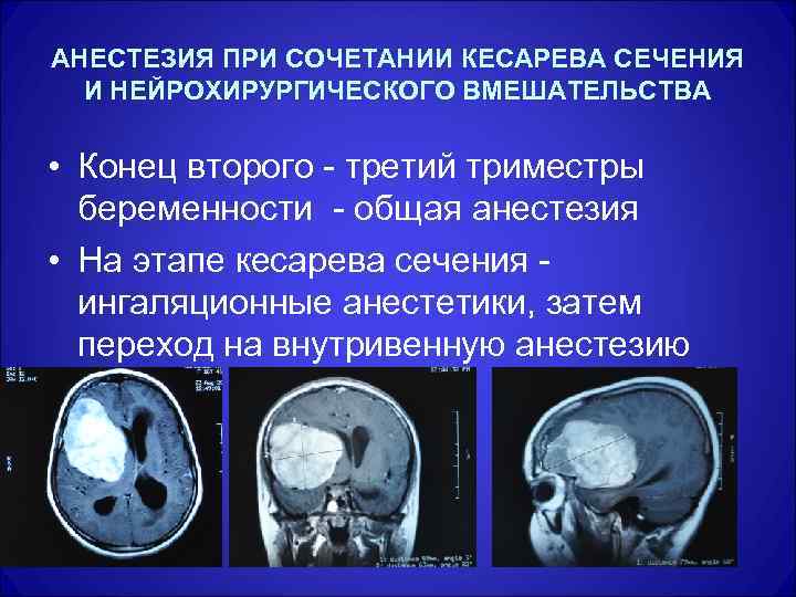 АНЕСТЕЗИЯ ПРИ СОЧЕТАНИИ КЕСАРЕВА СЕЧЕНИЯ И НЕЙРОХИРУРГИЧЕСКОГО ВМЕШАТЕЛЬСТВА • Конец второго - третий триместры