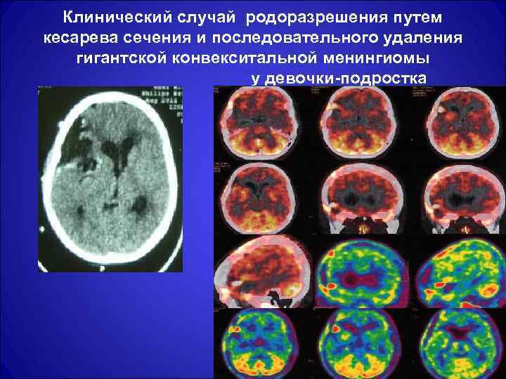 Клинический случай родоразрешения путем кесарева сечения и последовательного удаления гигантской конвекситальной менингиомы у девочки-подростка