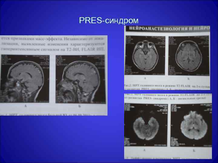 PRES-синдром 