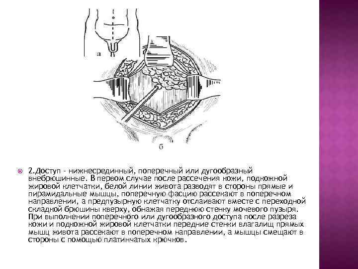  2. Доступ - нижнесрединный, поперечный или дугообразный внебрюшинные. В первом случае после рассечения