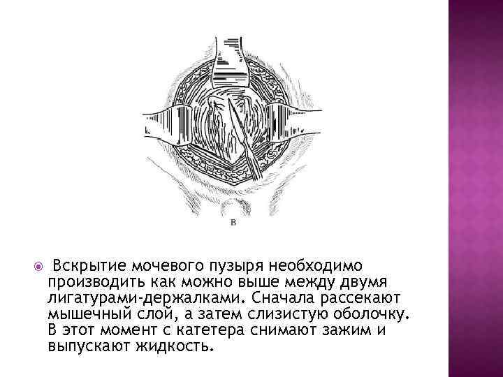  Вскрытие мочевого пузыря необходимо производить как можно выше между двумя лигатурами-держалками. Сначала рассекают