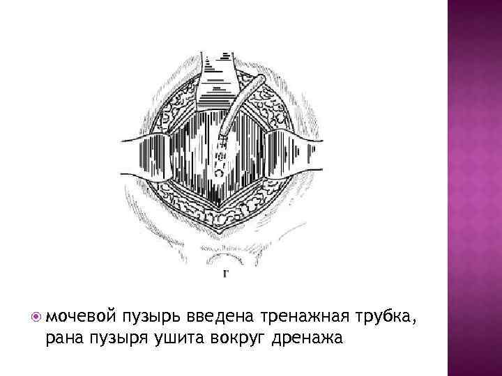  мочевой пузырь введена тренажная трубка, рана пузыря ушита вокруг дренажа 