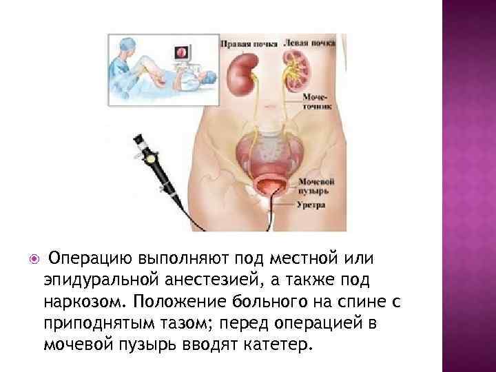 Операцию выполняют под местной или эпидуральной анестезией, а также под наркозом. Положение больного