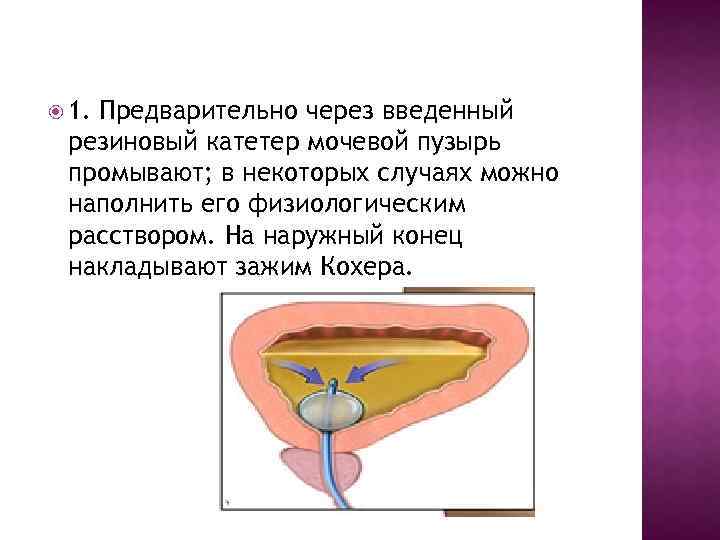  1. Предварительно через введенный резиновый катетер мочевой пузырь промывают; в некоторых случаях можно