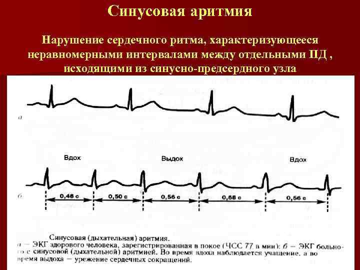 Синусовая аритмия Нарушение сердечного ритма, характеризующееся неравномерными интервалами между отдельными ПД , исходящими из