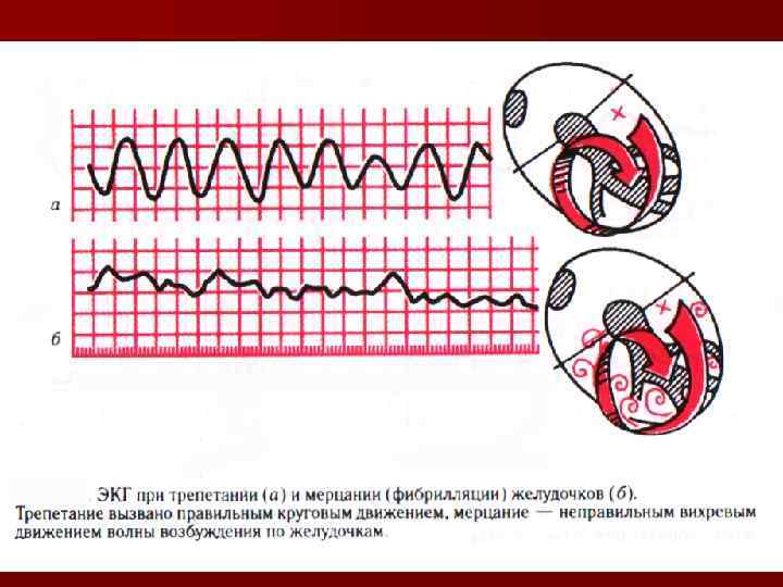 Мерцание на экг. Трепетание и фибрилляция желудочков на ЭКГ. Трепетание и мерцание желудочков на ЭКГ. ЭКГ при фибрилляции желудочков. Мелковолновая фибрилляция желудочков ЭКГ.