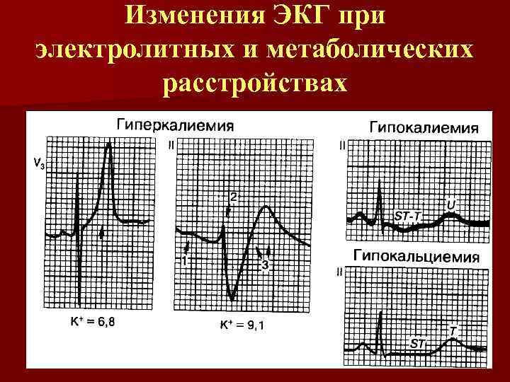 Экг при гиперкалиемии картинки