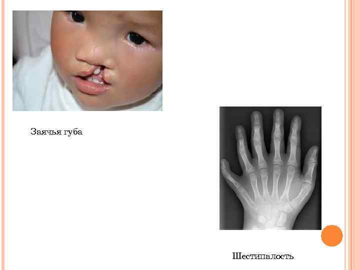 Заячья губа Шестипалость 