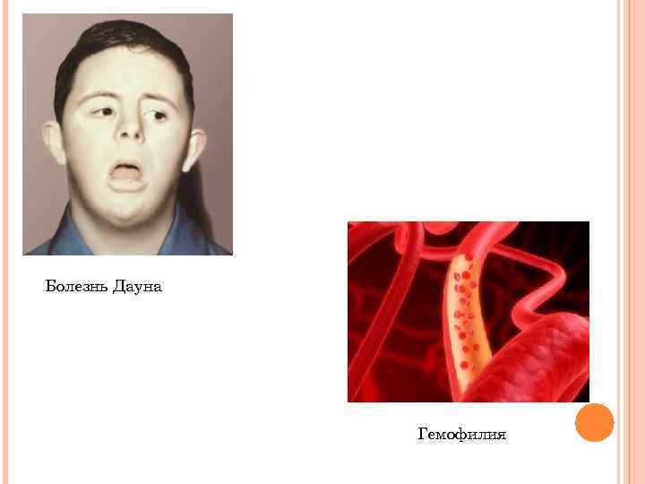 Болезнь Дауна Гемофилия 